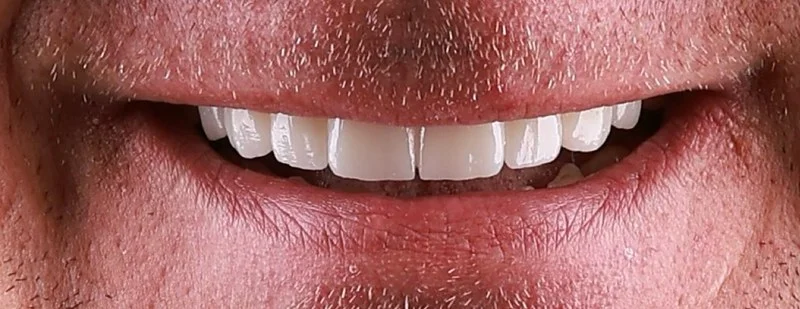 Efekty leczenia implantologicznego po zabiegu — dr Sawicki Warszawa